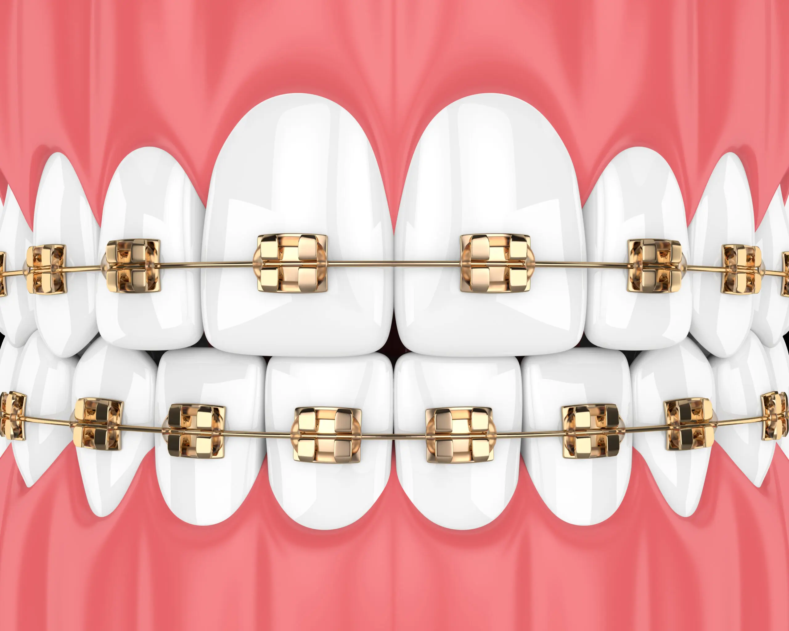 Gold braces
