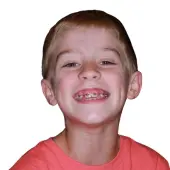 early orthodontic treatment cary nc