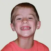 marsh orthodontics early treatment