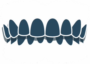 Overbite