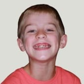 marsh orthodontics early treatment